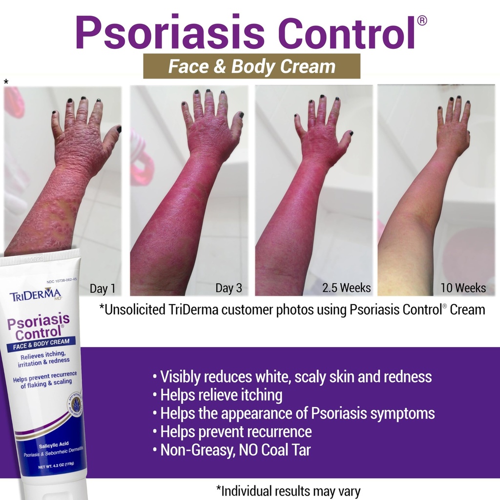 triderma-psoriasis-control-face-body-cre-3.jpg