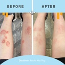 psoriasis-honey-skin-renewing-cream-ecze-4.jpg
