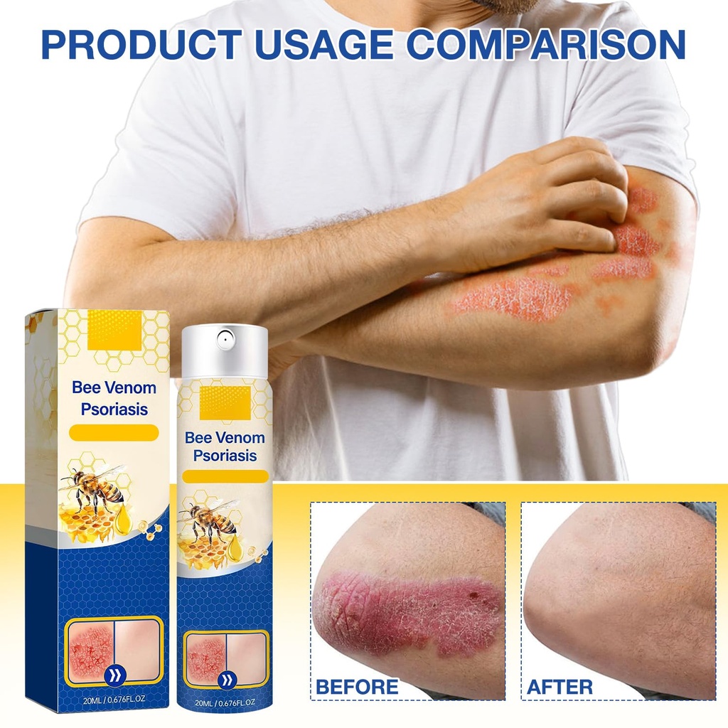 cuoct-2-pcs-psoriaheal-bee-venom-psorias-5.jpg