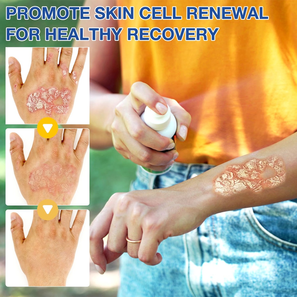 cuoct-2-pcs-psoriaheal-bee-venom-psorias-2.jpg