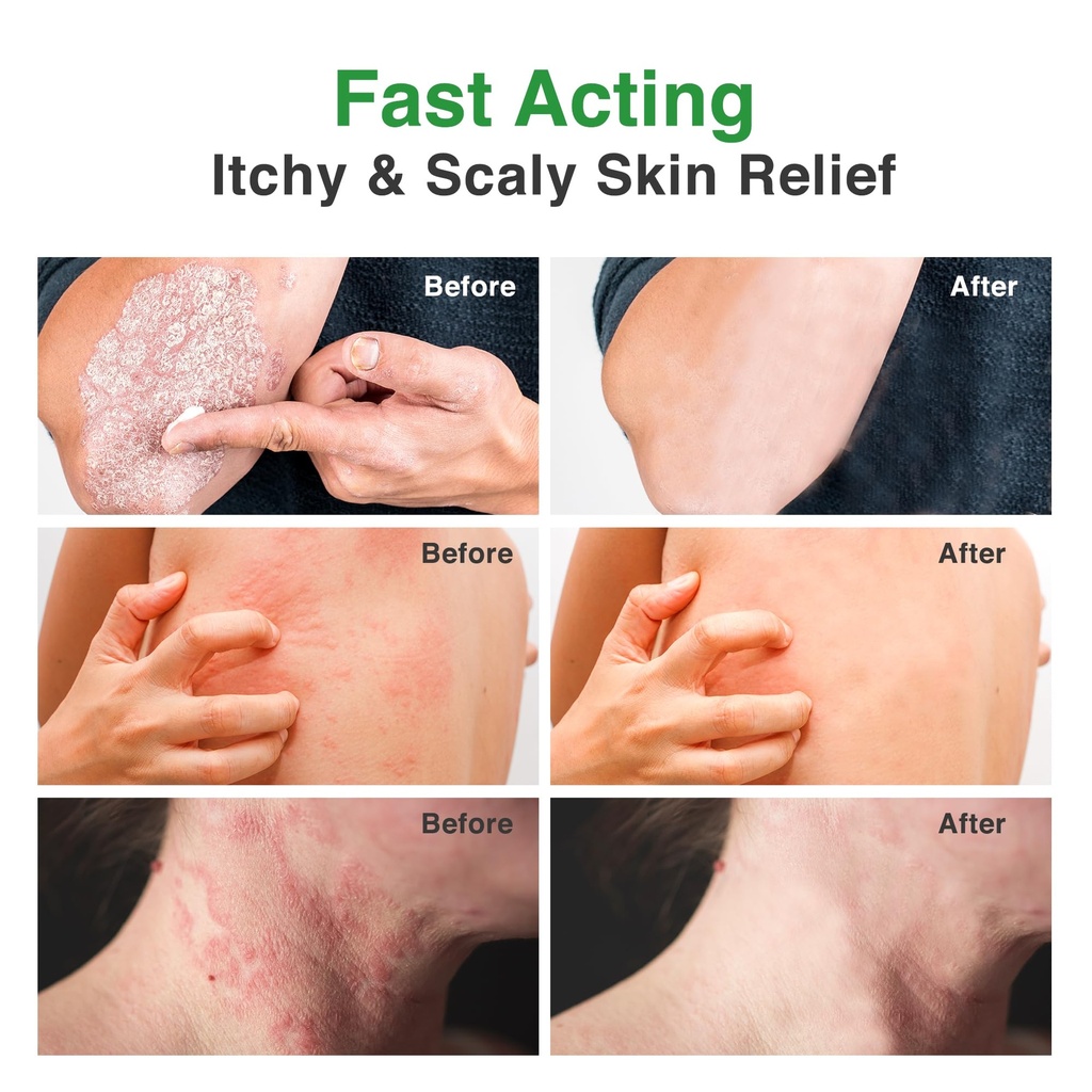 pleno-ringworm-treatment-for-humans-anti-4.jpg