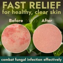 tinea-versicolor-treatment-antifungal-sp-5.jpg