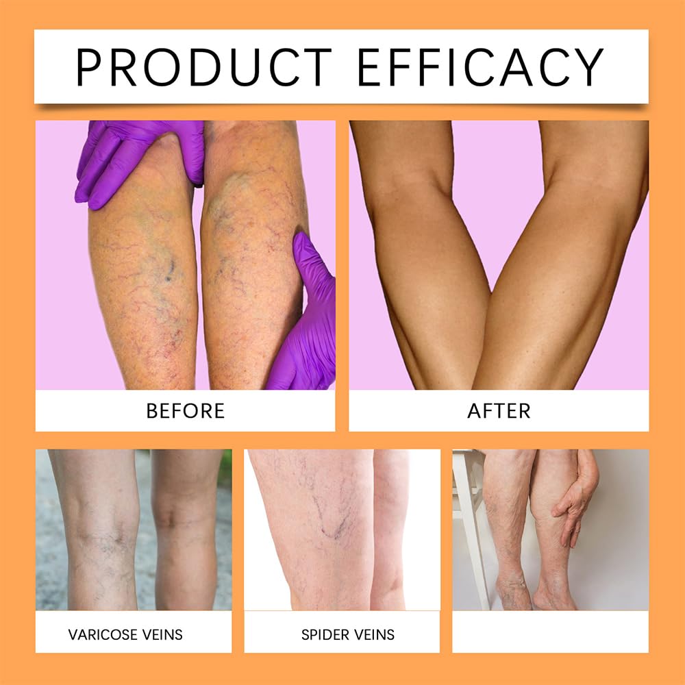 48-pcs-varicose-veins-treatment-for-legs-3.jpg