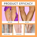 48-pcs-varicose-veins-treatment-for-legs-2.jpg