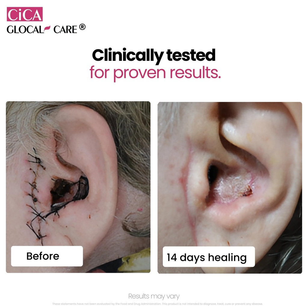 glocalcare-cica-clinically-proven-wound--6.jpg