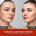 zafinco-acne-cure-cream-for-women-and-me-3.jpg
