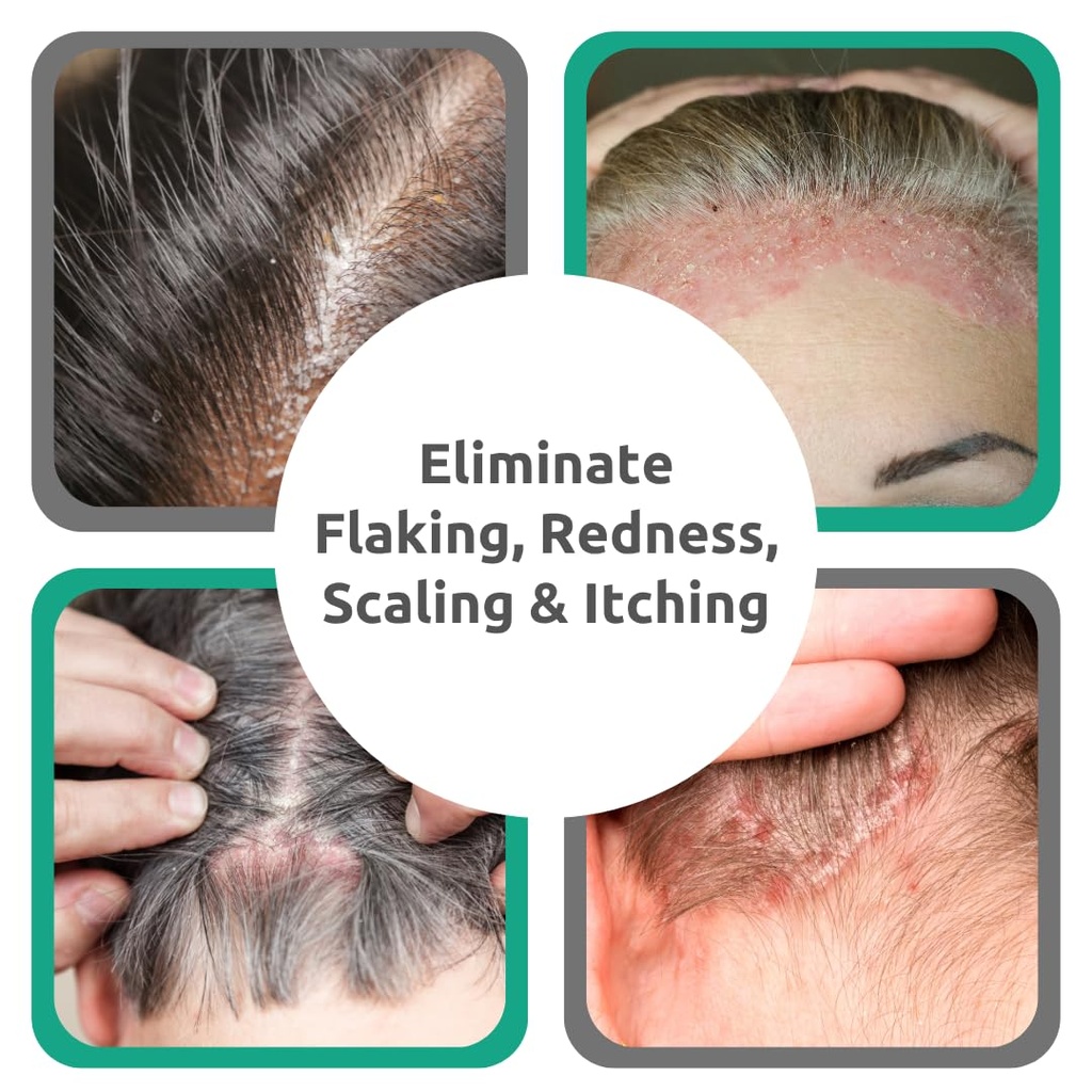 dr-blaine-s-scalp-psoriasis-serum-for-it-3.jpg