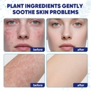 seborrheic-dermatitis-psoriasis-care-cre-4.jpg