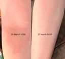 porphose-eczema-relief-spray-for-kids-an-3.jpg
