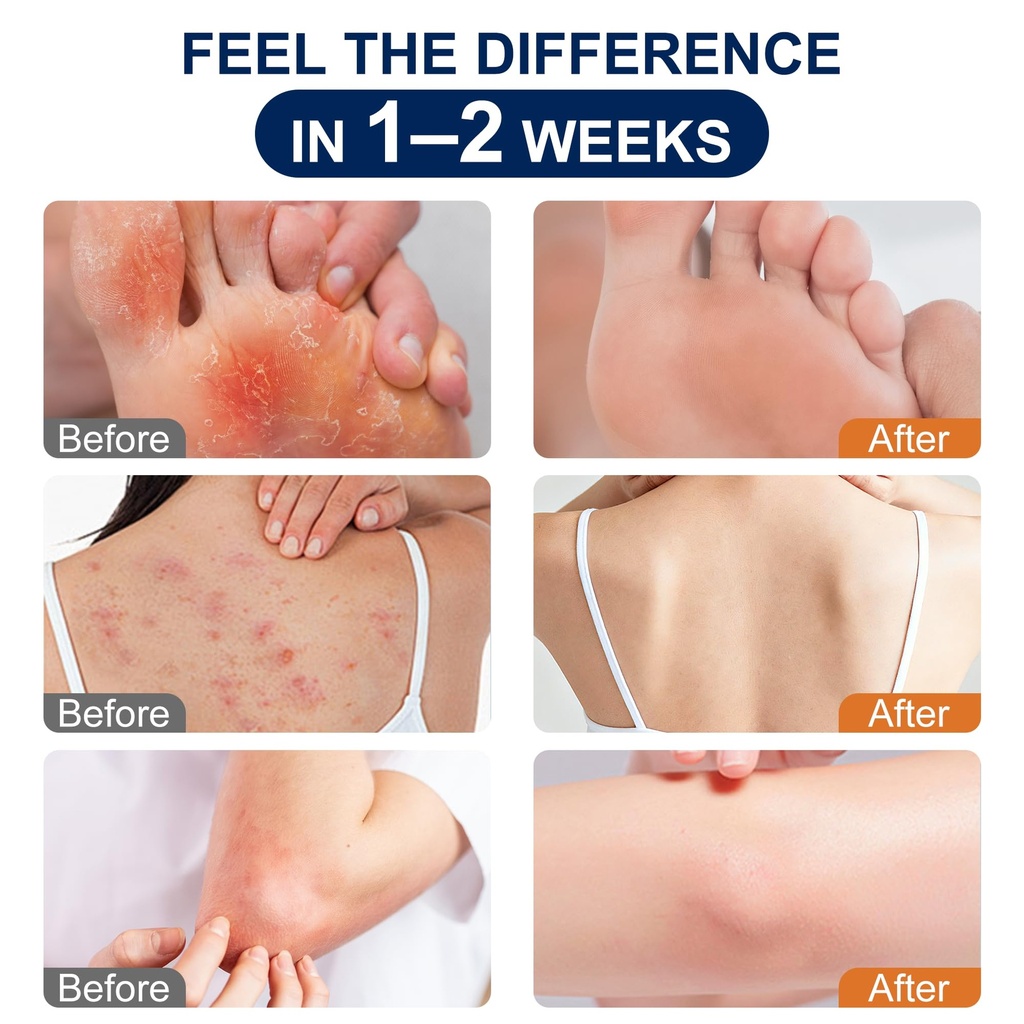 antifungal-cream-for-jock-itch-athletes--3.jpg