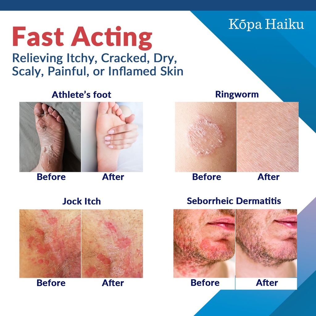 kopa-haiku-antifungal-cream-treatment-fo-3.jpg
