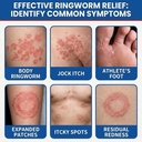 antifungal-ringworm-treatment-cream-mico-3.jpg