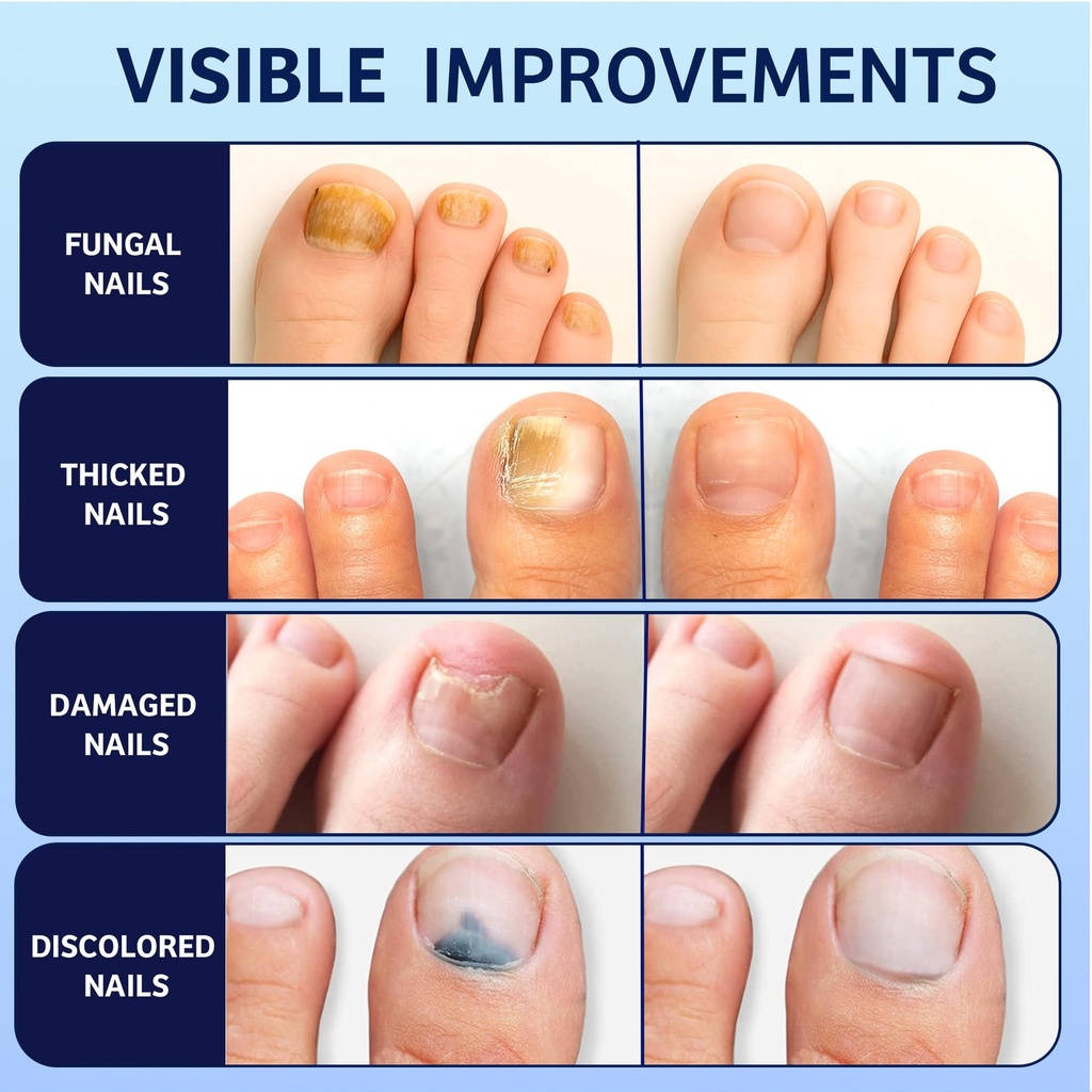 meoly-toenail-fungus-treatment-extra-str-5.jpg