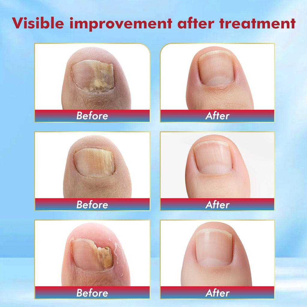 fungal-nail-treatment-swabs-50ct-extra-s-3.jpg