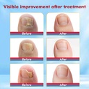 fungal-nail-treatment-swabs-50ct-extra-s-3.jpg