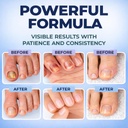 toenail-fungus-treatment-extra-strength--5.jpg