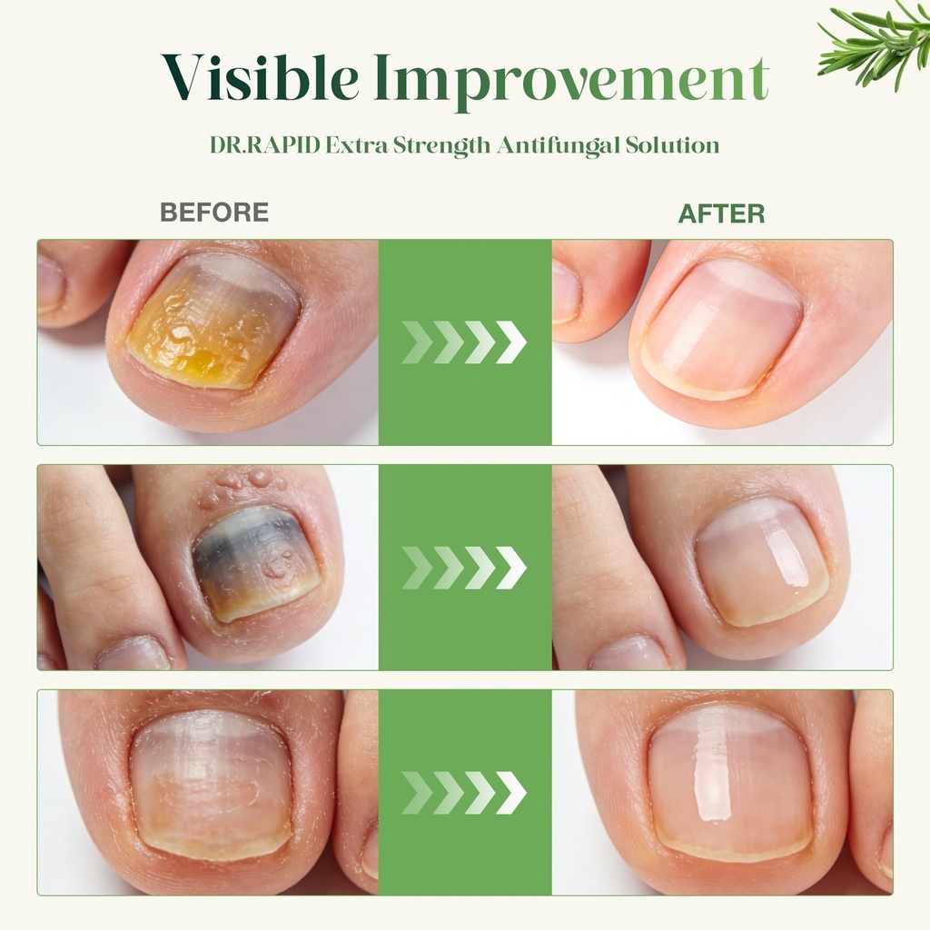 toenail-fungus-treatment-extra-strength--3.jpg