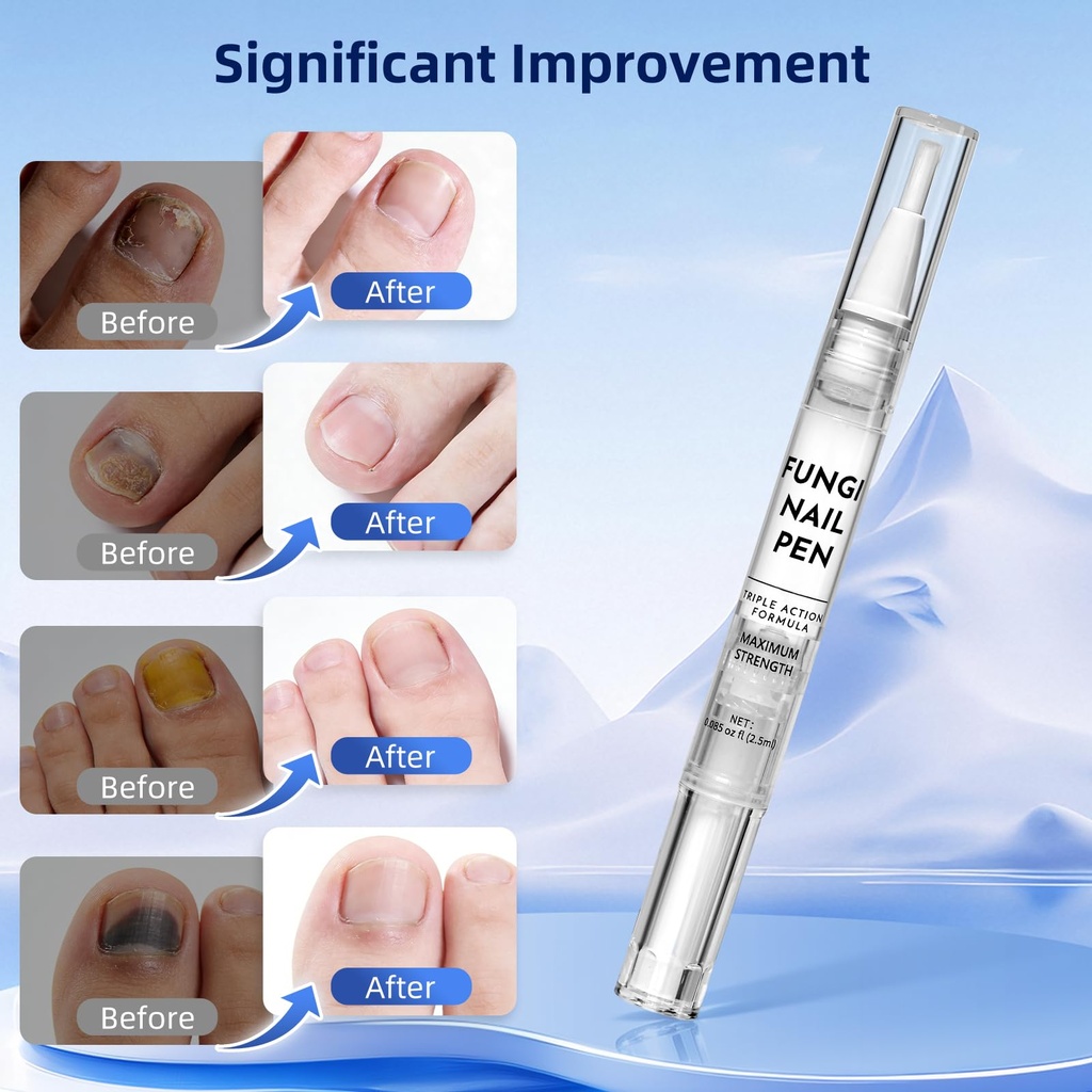toenail-fungus-pen-with-25-undecylenic-a-5.jpg