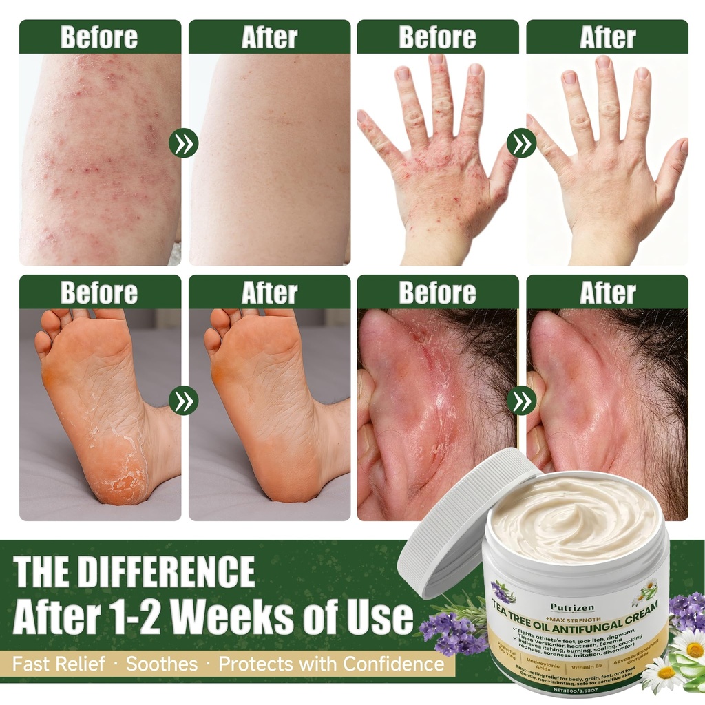 antifungal-cream-with-tea-tree-oil-advan-3.jpg