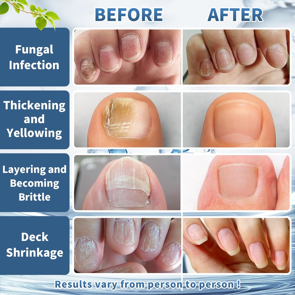 maximum-strength-nail-fungi-treatment-ex-5.jpg