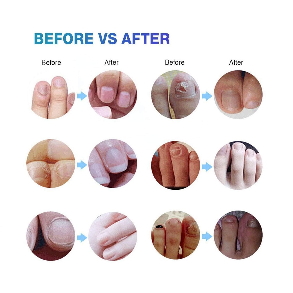 toenail-fungus-treatment-extra-strength--4.jpg
