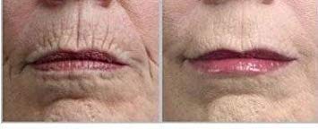 gaba-freeze-24-7-skin-tightening-firming-4.jpg