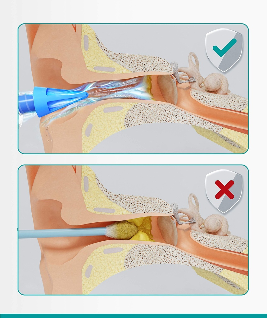 medi-grade-ear-syringe-ear-wax-removal-w-5.jpg