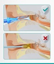 medi-grade-ear-syringe-ear-wax-removal-w-5.jpg