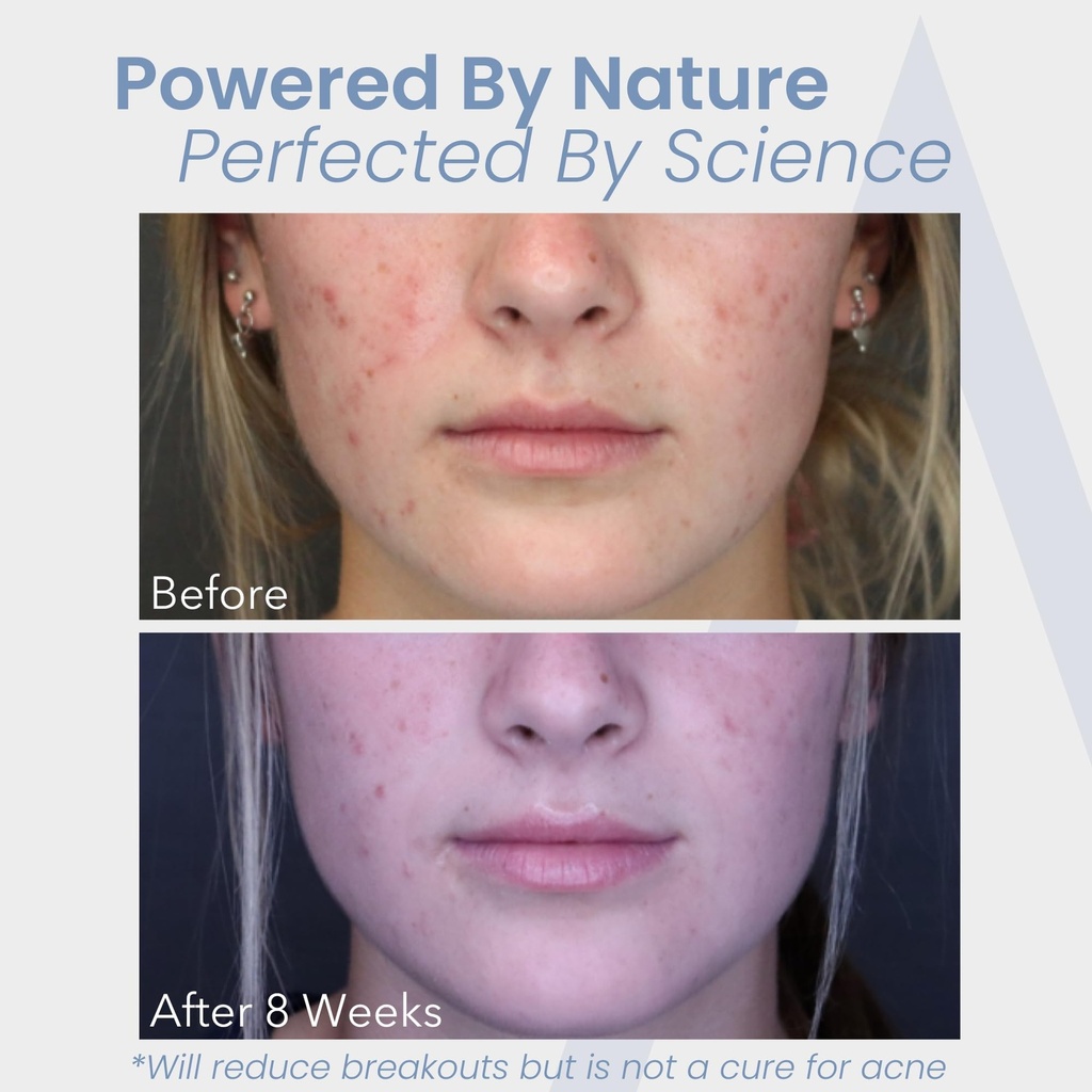 hormonal-acne-treatment-for-women-no-dim-5.jpg