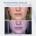 hormonal-acne-treatment-for-women-no-dim-5.jpg