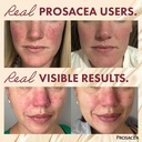 prosacea-medicated-rosacea-treatment-for-4.jpg