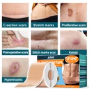 arme-silicone-scar-tape-silicone-scar-sh-6.jpg