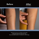 scaraway-advanced-skincare-silicone-scar-3.jpg