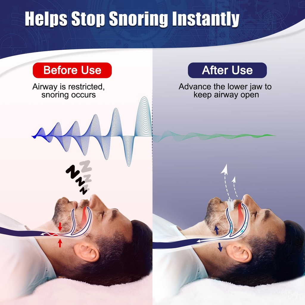 anti-snore-mouth-guard-anti-snoring-mout-2.jpg