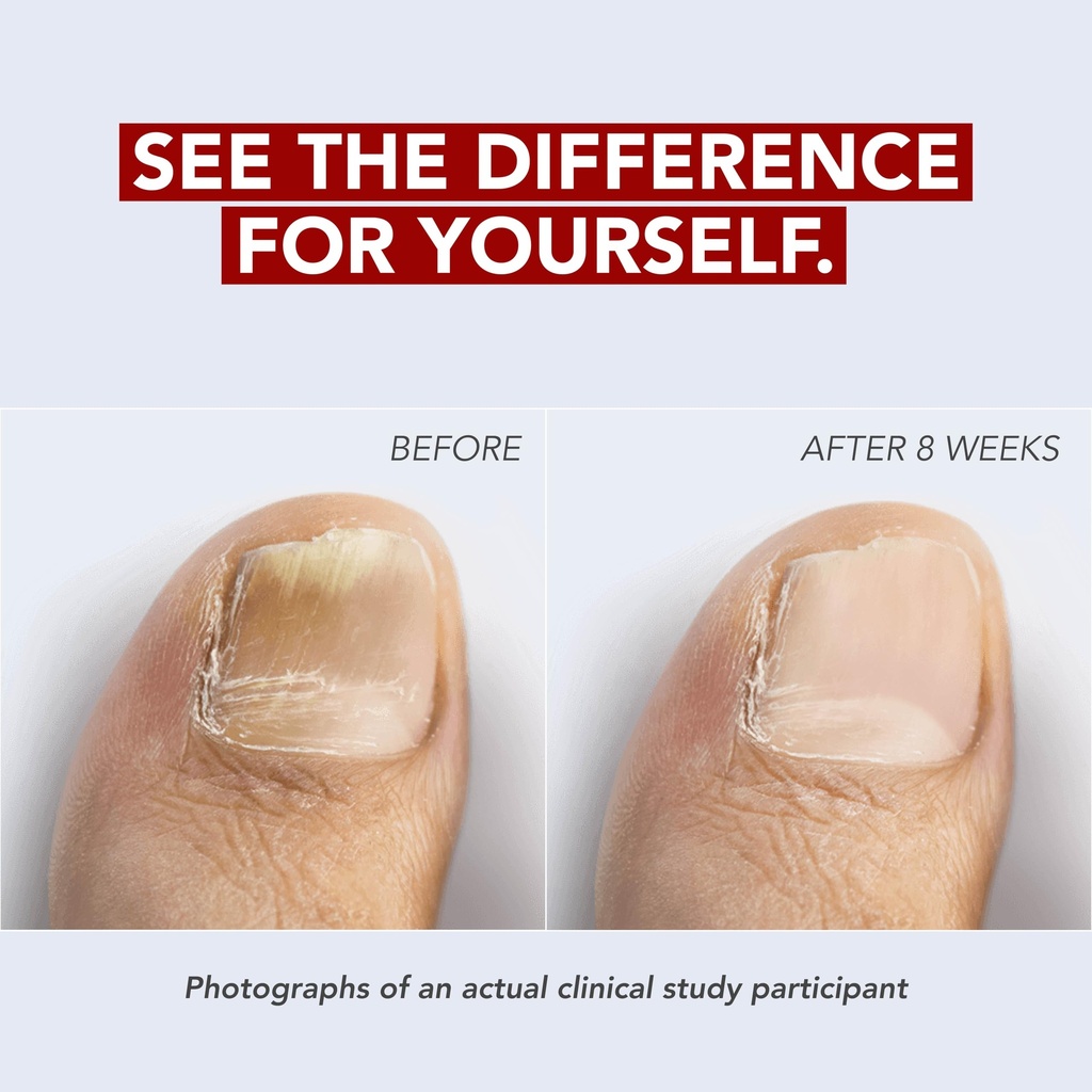 kerasal-nail-renewal-restores-appearance-4.jpg