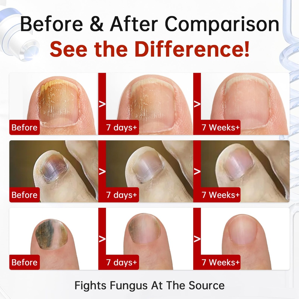 toenail-fungus-treatment-extra-strength--3.jpg