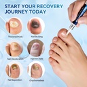 nail-fungus-treatment-pen-5-count-25-und-3.jpg