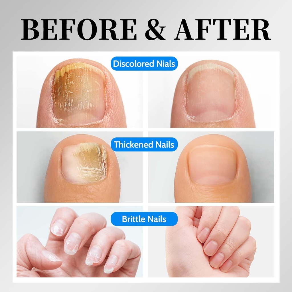 osimoon-toenail-fungus-treatment-extra-s-4.jpg