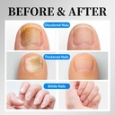 osimoon-toenail-fungus-treatment-extra-s-4.jpg