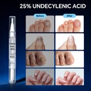 toenail-fungus-pen-with-25-undecylenic-a-3.jpg