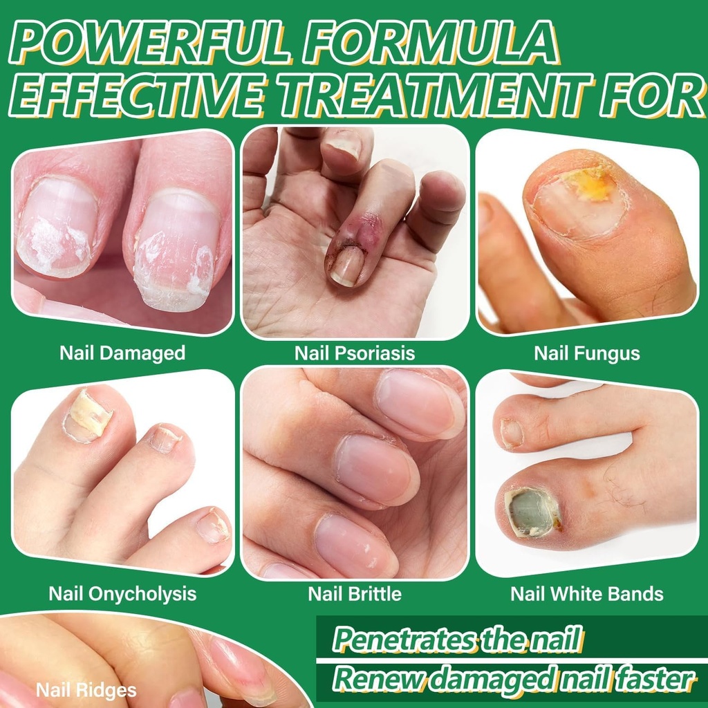 toenail-fungus-treatment-extra-strength--4.jpg
