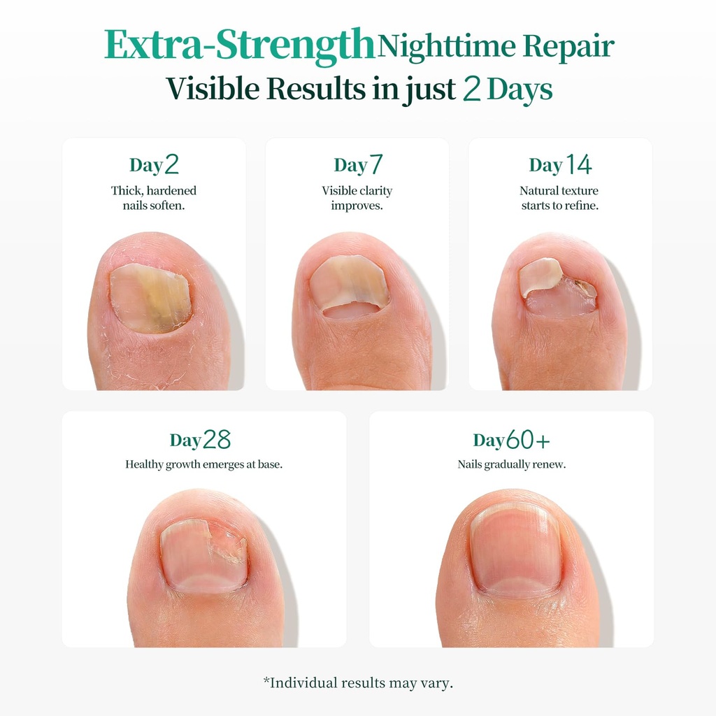 apuree-fungal-nail-patches-extra-strengt-4.jpg
