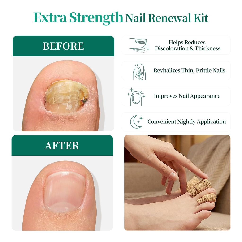 apuree-fungal-nail-patches-extra-strengt-2.jpg