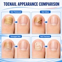 toenail-fungus-treatment-extra-strength--2.jpg
