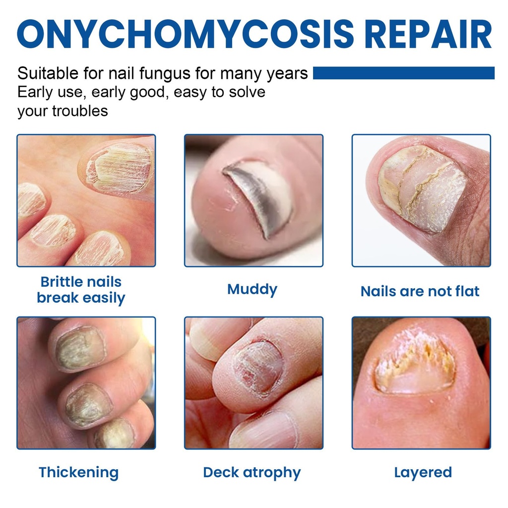 fungal-nail-patches-60-pcs-upgraded-toe--2.jpg