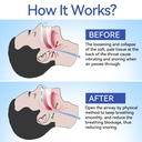 anti-snoring-devices-anngola-snoring-sol-2.jpg