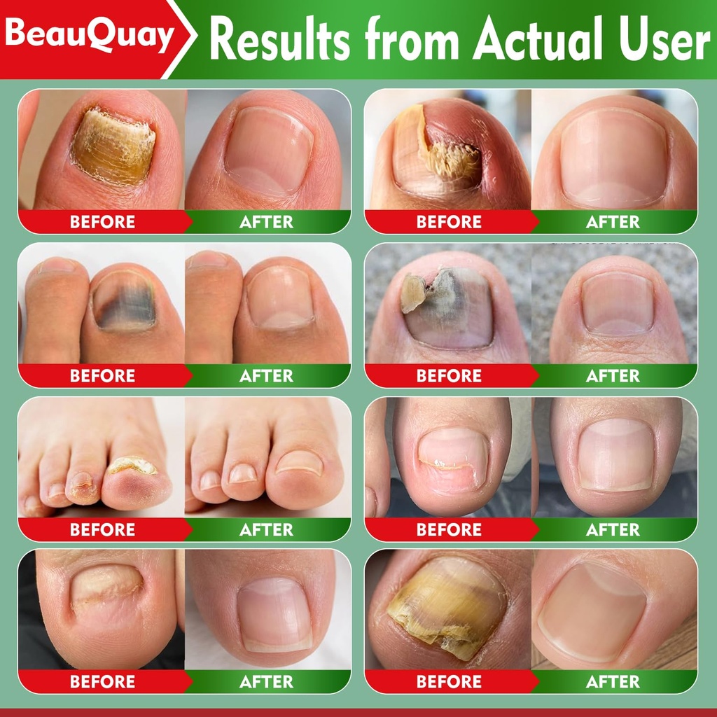 toenail-fungus-treatment-extra-strength--4.jpg