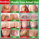 toenail-fungus-treatment-extra-strength--4.jpg