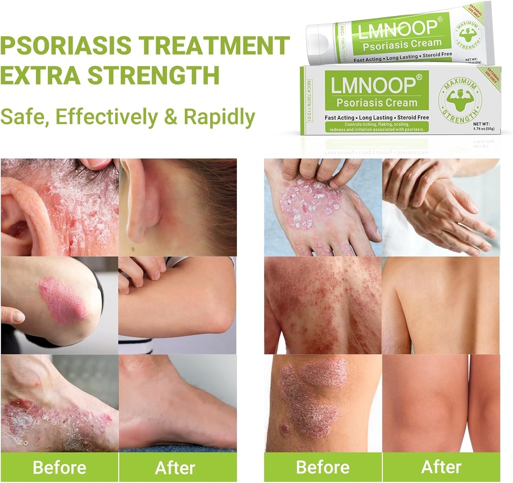 psoriasis-cream-maximum-strength-treatme-5.jpg