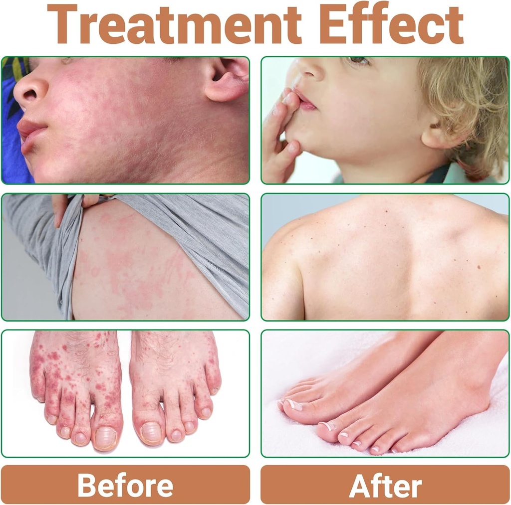 urticaria-cream-hives-relief-advanced-fo-5.jpg